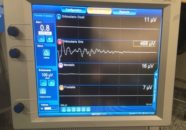 Neuro monitoring